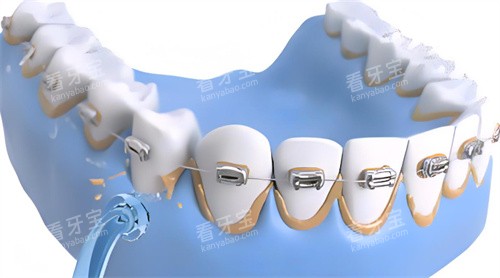 洗牙过程动画展示图片 洗牙过程动画展示图片