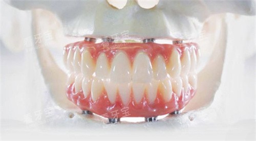 全口种植牙卡通图 全口种植牙卡通图