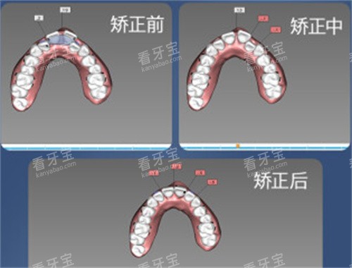 牙齿矫正设计图 牙齿矫正设计图