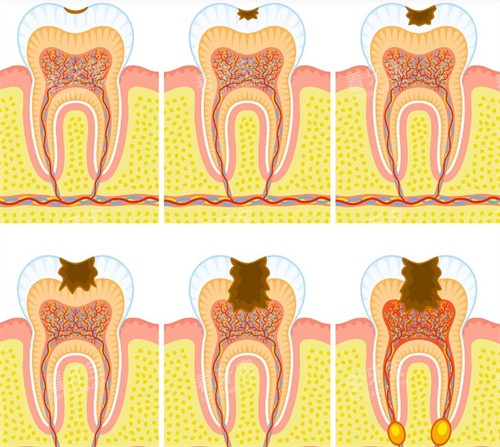 牙齿逐步变蛀牙过程 牙齿逐步变蛀牙过程