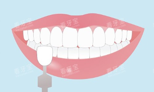 牙齿贴面示意图 牙齿贴面示意图
