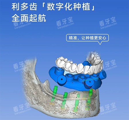 利多齿种植牙怎么样 利多齿种植牙怎么样