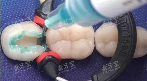 儿童补牙材料 儿童补牙材料