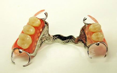 活动假牙示意图 活动假牙示意图