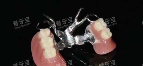 活动义齿维他灵支架示意图 活动义齿维他灵支架示意图