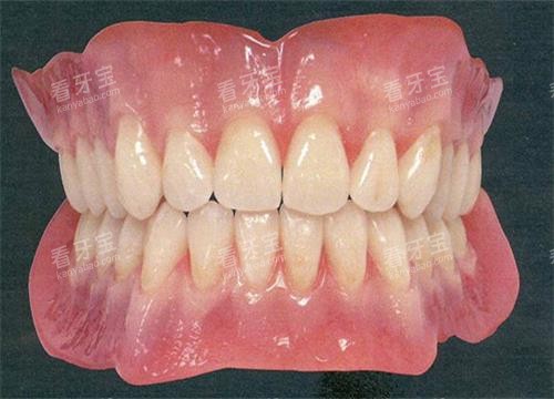 活动假牙全口示意图 活动假牙全口示意图