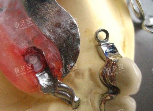 假牙挂钩细节图 假牙挂钩细节图