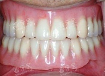 假牙照片 假牙照片