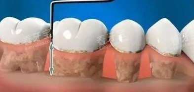 种植牙手术图片 种植牙手术图片