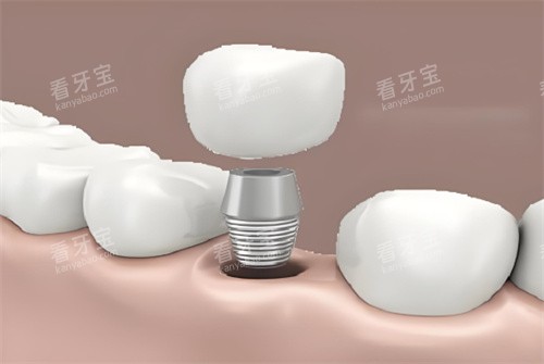 种植牙图片展示图片 种植牙图片展示图片