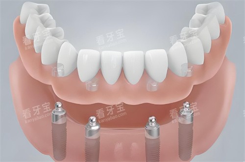 半口种植牙模型图展示 半口种植牙模型图展示