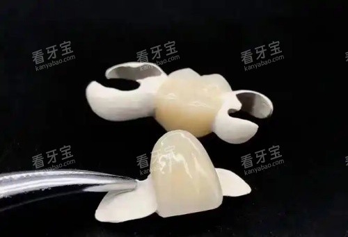 hpp粘接桥牙齿示意图 hpp粘接桥牙齿示意图