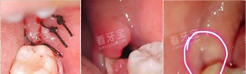 拔智齿缝合示意图 拔智齿缝合示意图