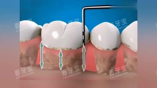 牙周刮治漫画图 牙周刮治漫画图