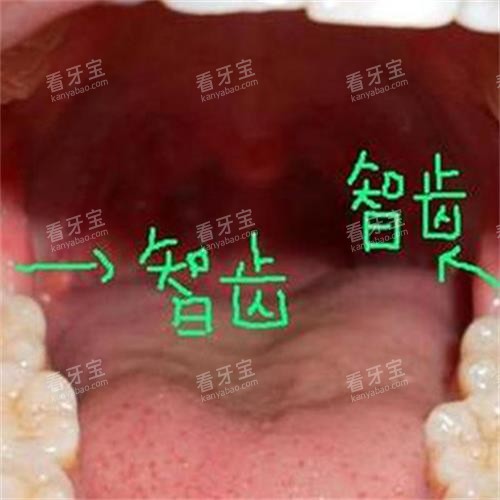 牙齿智齿所在位置 牙齿智齿所在位置