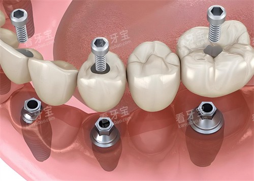 ��Ӻ�ؿڱ����õ����������Ƽ��������˲�����������������������5���������ƣ�ͬ��/����/���Ƶ��ϰ�