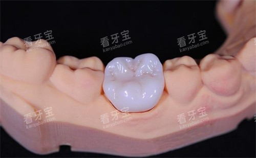 全瓷牙冠 全瓷牙冠