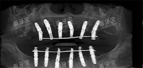 全口种植ct图片 全口种植ct图片