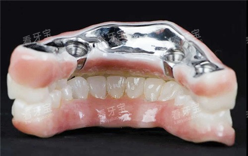 钛合金全口义齿 钛合金全口义齿