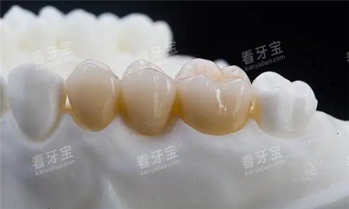 全瓷牙冠图 全瓷牙冠图
