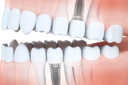 种植牙植入口腔图解 种植牙植入口腔图解