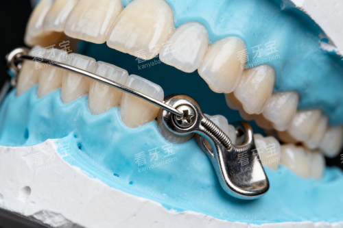 牙齿安装保持器一览 牙齿安装保持器一览