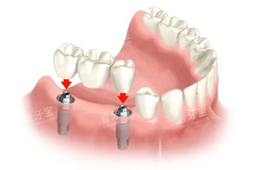 种植牙冠安装示意图 种植牙冠安装示意图