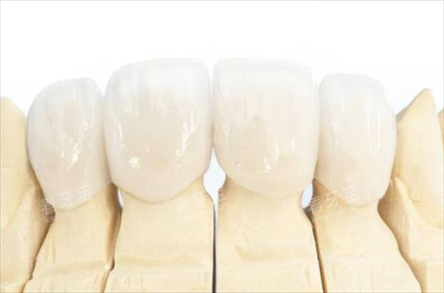 全瓷牙冠佩戴模型展示 全瓷牙冠佩戴模型展示