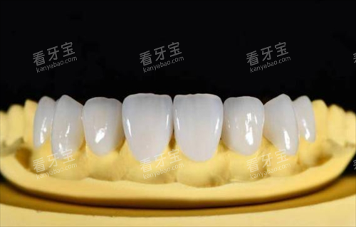 全瓷牙模拟展示 全瓷牙模拟展示