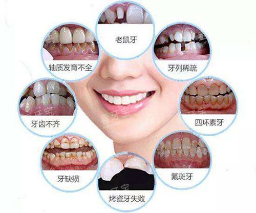牙齿贴面情况示意图 牙齿贴面情况示意图