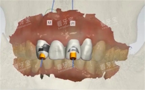 数字化种植设计图 数字化种植设计图