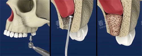 上颌窦提升手术示意图 上颌窦提升手术示意图