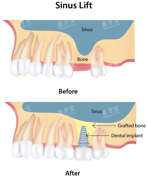 上颌窦提升前后对比 上颌窦提升前后对比