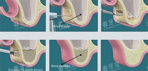 上颌窦提升手术过程 上颌窦提升手术过程