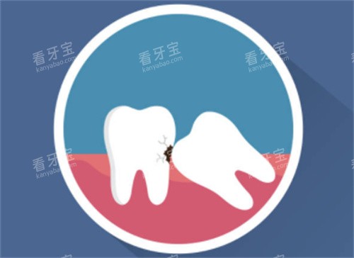 牙齿拥挤示意图 牙齿拥挤示意图