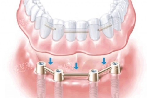 all-on-4��ֲ��ͨչʾͼ