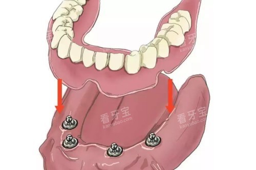 all-on-4��ֲģ��Ԥ��ͼ