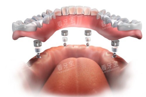 all-on-4��ֲģ��ͼ