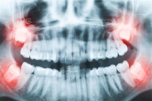 牙齿拍片图 牙齿拍片图
