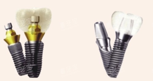 不同材质的种植牙 不同材质的种植牙