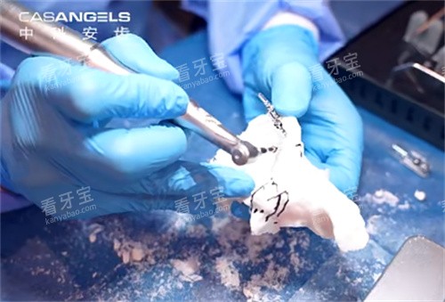 中科安齿种植牙操作过程 中科安齿种植牙操作过程