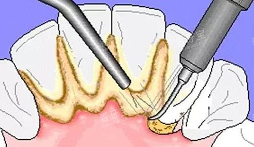 牙结石超声波洁牙示意图 牙结石超声波洁牙示意图
