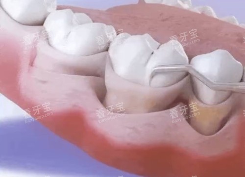 牙周刮治卡通示意图 牙周刮治卡通示意图