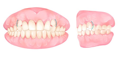 牙列拥挤 牙列拥挤