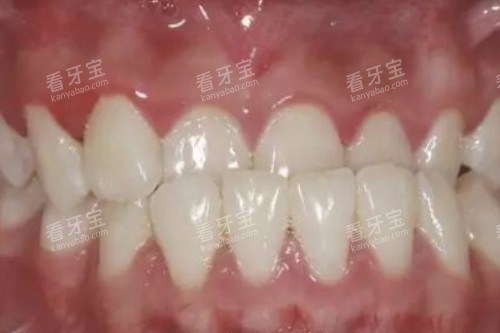 牙齿地包天卡通图 牙齿地包天卡通图