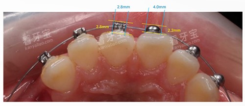���ݽ���OBrace�����в۶Աȷ����в۴�С