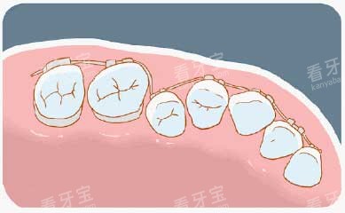 牙齿矫正漫画牙齿图 牙齿矫正漫画牙齿图