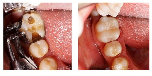 ��֬����ǰ��