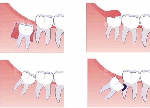 智齿不同部位示意图 智齿不同部位示意图