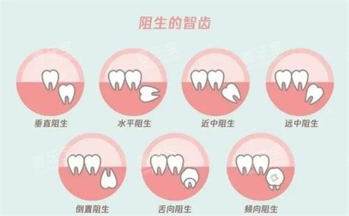 阻生智齿的示意图 阻生智齿的示意图